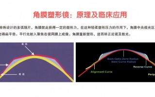 mct角膜塑形镜怎么样，角膜塑形镜的作用