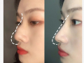 鼻梁高适合什么鼻托，鼻梁高但是鼻头大是什么鼻型