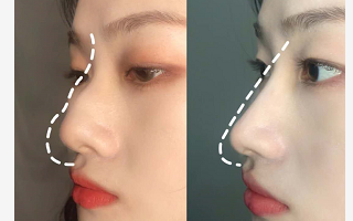 鼻梁高适合什么鼻托，鼻梁高但是鼻头大是什么鼻型